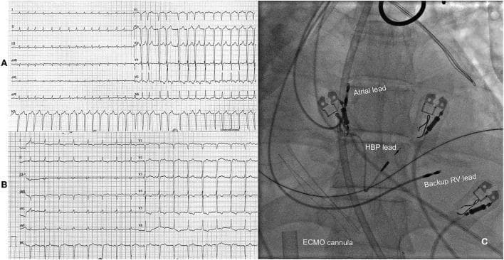 This composite educational image illustrates the management of refractory tachycardia-induced cardiomyopathy. Panel A presents a 12-lead electrocardiogram (ECG) showing atrial fibrillation with a rapid ventricular response (tachyarrhythmia). The tracing is characterized by absent P waves, irregular R-R intervals, and narrow QRS complexes at a rate of approximately 175 bpm. Panel B displays a follow-up ECG after an 'ablate and pace' intervention, specifically showing a more controlled rhythm resulting from atrioventricular (AV) node ablation and subsequent His bundle pacing (HBP). Panel C is a fluoroscopic angiogram in a post-procedural state, depicting the anatomical placement of cardiac pacing leads. Key landmarks include the atrial lead positioned superiorly, the HBP lead situated in the region of the His bundle, and a backup right ventricular (RV) lead. A large, radiopaque extracorporeal membrane oxygenation (ECMO) cannula is visible in the background, crossing the cardiac silhouette. This content demonstrates advanced electrophysiological strategies and mechanical circulatory support in the context of cardiogenic shock and refractory arrhythmia.