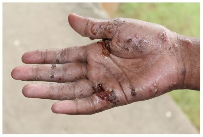 This clinical photograph displays the palmar surface and interdigital spaces of a hand with significant dermatological pathology. The primary findings include widespread papules, nodules, and burrows characteristic of Sarcoptes scabiei infestation. There is prominent evidence of secondary bacterial infection (impetiginization), manifested as honey-colored and dark hemorrhagic crusting, pustules, and focal ulcerations. The distribution is densest in the web spaces, particularly between the thumb and index finger, and along the proximal phalanges. Visible skin changes include erythema, inflammatory thickening, and xerosis. This image serves as a clinical example of neglected scabies and its common complications, such as secondary infection by Staphylococcus aureus or Streptococcus pyogenes, which can lead to serious systemic sequelae if left untreated. The presentation is typical for endemic regions where public health burdens of tropical skin diseases are high.