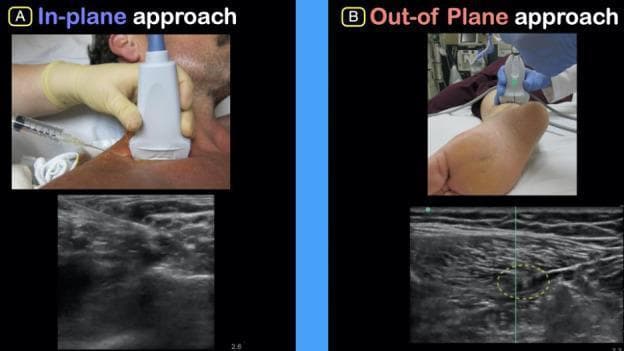 This composite educational image demonstrates ultrasound-guided regional anesthesia techniques, comparing in-plane and out-of-plane needle approaches for a peripheral tibial nerve block. Section A (left) displays the in-plane approach, featuring a clinical photograph of the transducer-needle orientation and a corresponding sonogram. The sonogram shows the needle shaft and tip clearly visualized in the longitudinal axis, entering from the lateral aspect toward the target nerve. Anechoic fluid (local anesthetic) is visible accumulating around the nerve structure. Section B (right) illustrates the out-of-plane approach, showing the needle tip appearing as a hyperechoic dot as it transects the ultrasound beam's short axis. The target nerve is demarcated by a dashed yellow ellipse, surrounded by hypoechoic tissue. The graphic serves to teach needle-beam alignment, sonographic visualization of injectate distribution, and spatial orientation during ultrasound-guided interventions. It is intended for intermediate medical training in anesthesiology and emergency medicine.