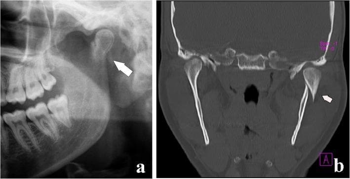 This medical comparison image features two diagnostic modalities illustrating a mandibular condylar process fracture with displacement. Image (a) is a cropped panoramic radiograph showing a radiolucent fracture line across the condylar neck with a clear step-off deformity (arrow), indicating misalignment of the bone fragments. Image (b) provides a computed tomography (CT) coronal section, which offers superior visualization of the three-dimensional relationship between the fractured segments. The CT confirms a displaced fracture of the left condyle where the distal fragment is shifted medially and lacks direct cortical contact with the mandibular ramus. Crucially, both images demonstrate that while there is significant displacement of the bone fragments, the condylar head itself remains seated within the glenoid fossa of the temporal bone, classifying this as a displaced fracture rather than a dislocation according to the MacLennan classification. These visuals are essential for oral and maxillofacial surgery education to distinguish between types of condylar injuries and determine the appropriate surgical or conservative management strategy.