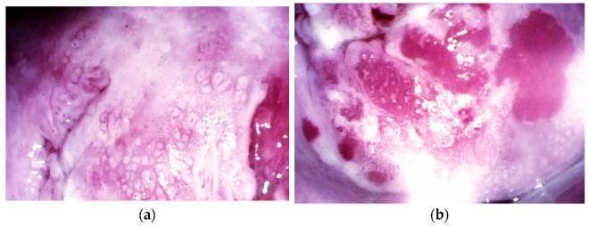 This set of clinical photographs obtained via colposcopy (14x magnification) illustrates early-stage cervical cancer presentations. Image (a) depicts a microinvasive lesion of the cervix, showing a complex, textured surface with prominent acetowhite patterns, reticular mosaicism, and areas of punctate vascularity. The tissue appears uneven with alternating pink and pale white zones, indicating dysplastic epithelial changes. Image (b) shows a stage IA2 squamous cell carcinoma characterized by significant vascular atypia. Visible features include irregular, deep pink atypical vessels with varying diameters and corkscrew or comma-like morphologies. The surface is nodular and heterogeneous, featuring raised exophytic areas and intense focal hyperemia. These images serve as educational examples for identifying high-grade cervical intraepithelial lesions and early invasive squamous cell carcinoma during diagnostic colposcopic evaluation, highlighting the importance of vessel morphology and surface texture in oncologic staging.