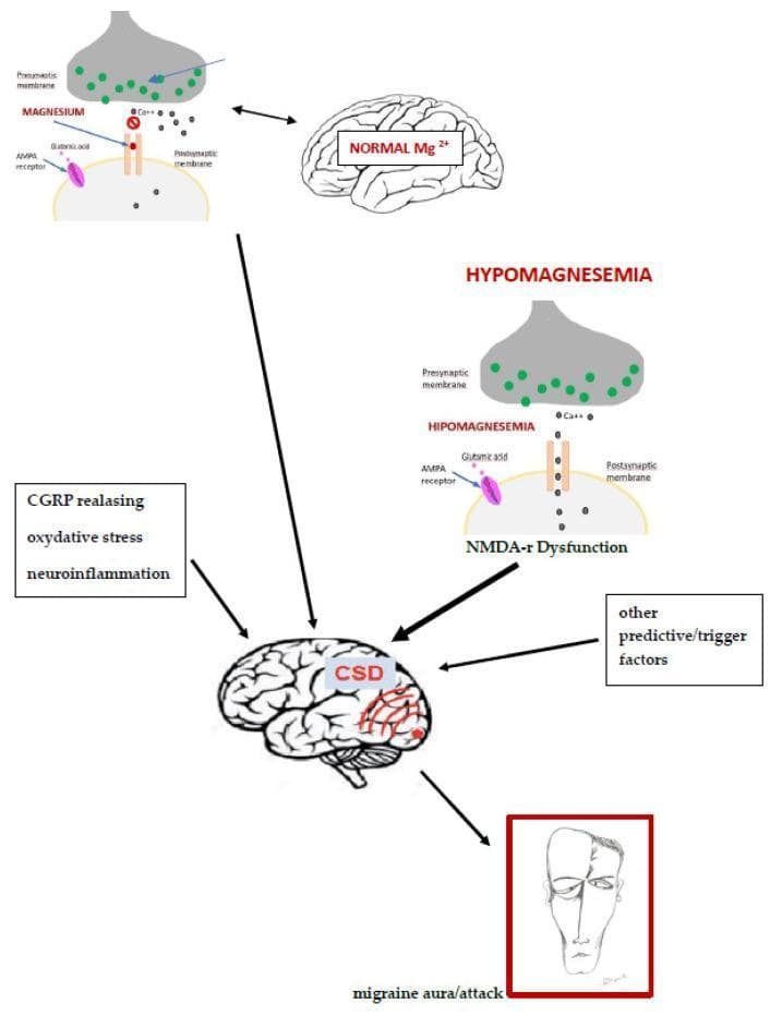 This pathophysiology diagram illustrates the role of magnesium in migraine pathogenesis and synaptic transmission. The top section compares a synapse under 'NORMAL Mg2+' conditions with one in 'HYPOMAGNESEMIA'. In the normal state, the NMDA receptor is shown with a magnesium block, regulating calcium (Ca++) entry. In the hypomagnesemia state, the block is absent, leading to 'NMDA-r Dysfunction' and increased ion flux. The diagram depicts key synaptic components including the presynaptic membrane with neurotransmitter vesicles, the postsynaptic membrane with AMPA and NMDA receptors, and glutamic acid signaling. The central flow shows how hypomagnesemia contributes to Cortical Spreading Depression (CSD), indicated on a brain illustration. Additional contributory factors shown include CGRP release, oxidative stress, neuroinflammation, and other trigger factors. The culmination of these processes is linked to 'migraine aura/attack,' represented by a facial illustration and a brain with focal excitatory waves. This diagram is designed for neurology and biochemistry education to explain the molecular mechanisms of magnesium deficiency in migraine development.