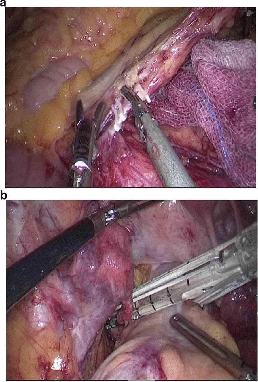 This composite clinical photograph depicts two key stages of a laparoscopic colorectal surgical procedure, specifically for rectal cancer resection. Panel A illustrates the laparoscopic dissection and ligation of the inferior mesenteric artery (IMA) at its root. The artery is visible as a central tubular structure, isolated with surgical graspers and secured with multiple white surgical clips prior to division. Surrounding anatomical features include the retroperitoneal adipose tissue and a purple surgical sponge used for tissue retraction and moisture control. Panel B demonstrates the distal rectal division using a laparoscopic linear stapler. The stapler's jaws are positioned perpendicularly across the 'naked' rectum, approximately 5 cm distal to the tumor site. The rectal tissue is compressed within the stapler, which simultaneously applies rows of titanium staples and cuts the tissue to achieve a secure distal margin closure. These images highlight standard oncological principles of high vascular ligation and clear distal margins in colorectal surgery.