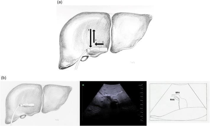 This composite educational graphic illustrates the technique for intraoperative ultrasound (IOUS) of the right portal vein. Panel (a) contains an anatomical diagram showing a T-style ultrasound probe placed on the surface of the liver. Numbered arrows (1-3) demonstrate the systematic scanning maneuvers (sliding and rolling) used to visualize the segmental branches of the right portal vein. Panel (b) correlates a specific probe placement over the right liver with a corresponding transverse ultrasound image and its labeled schematic. The ultrasound clearly identifies the right portal vein (RPV) and the right hepatic artery (RHA). The RHA is seen as a smaller tubular structure positioned inferior and slightly anterior to the RPV. The image highlights the use of hyperechoic portal vein walls and proximity to the hepatic hilum to define segmental anatomy. This visual serves as a procedural guide for surgeons to perform complete parenchymal and vascular exploration during hepatobiliary surgery.
