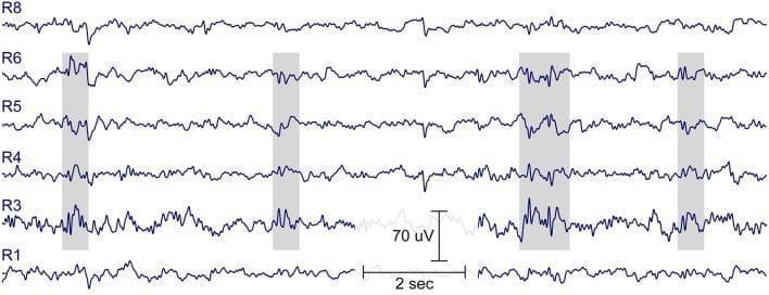 This diagnostic image displays 15 seconds of resting-state electroencephalogram (EEG) data recorded from a 7-year-old child using ear-EEG sensor technology (cEEGrid). The trace shows six active channels labeled R1 through R8, with scale indicators provided for 70 microvolts (uV) in amplitude and 2 seconds in time. The primary educational focus is the identification of interictal epileptiform discharges. Specifically, the image highlights four distinct occurrences of spike-wave activity, marked by gray shaded vertical bars. These epileptiform events are most prominent in channels R3, R4, R5, and R6, exhibiting a classic morphology consisting of sharp spikes immediately followed by slower wave components. While the subject is healthy with no seizure history, the record demonstrates subclinical epileptiform activity, which is clinically relevant in the context of a family history of Rolandic epilepsy (Benign Epilepsy with Centrotemporal Spikes). The image serves as an example of how localized ear-level EEG can capture temporal lobe epileptiform abnormalities.