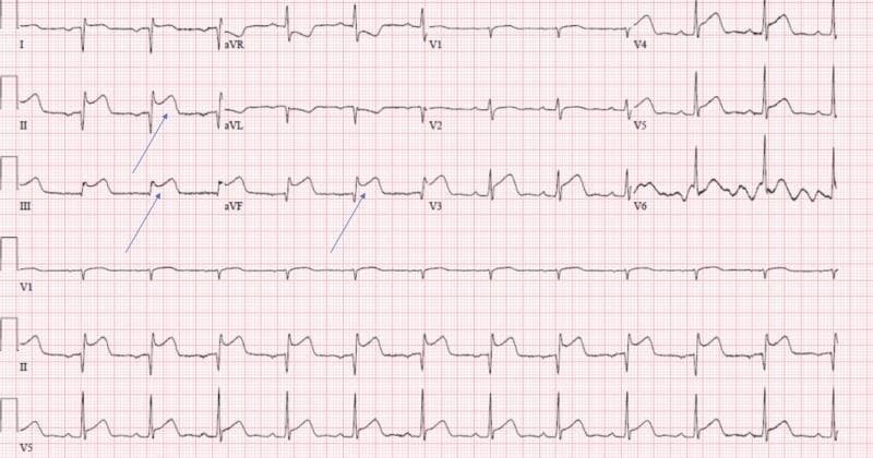 This diagnostic image is a 12-lead electrocardiogram (ECG) printed on standard red-grid paper, demonstrating findings consistent with an acute inferior wall ST-segment elevation myocardial infarction (STEMI). Significant ST-segment elevation is clearly visible in the inferior leads (II, III, and aVF), with the elevation in lead III being particularly prominent and exhibiting a convex-upward morphology. Reciprocal ST-segment depression is noted in the high lateral leads (I and aVL). Blue arrows in leads II, III, and aVF highlight the pathognomonic ST-segment displacement. The ECG also includes precordial leads V1-V6 and a rhythm strip at the bottom showing leads V1, II, and V5. Key educational features include the visualization of injury patterns in an anatomical vascular distribution (right coronary artery or left circumflex), making it an essential resource for students learning to identify acute coronary syndromes and distinguish between inferior and lateral wall changes.