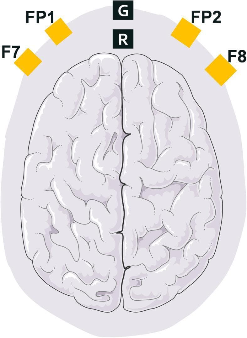 This anatomical diagram provides a superior view of the human brain, specifically illustrating the electrode montage for frontal-lobe electroencephalography (EEG) monitoring. The diagram highlights the placement of six electrodes relative to the cerebral cortex. Four active recording electrodes, marked by yellow squares, are positioned according to the International 10-20 system: FP1 and FP2 (pre-frontal) and F7 and F8 (frontal-temporal), situated over the frontal lobes of the left and right hemispheres respectively. Additionally, two central electrodes are positioned along the midline (longitudinal fissure): 'G' representing the Ground electrode and 'R' representing the Reference electrode. This specific array is commonly used in clinical anesthesia and critical care to monitor brain function, depth of sedation, and to perform coherence analysis during drug-induced loss of consciousness. The illustration effectively demonstrates the spatial distribution required for capturing bipolar frontal channel data in neurophysiological research and clinical monitoring.
