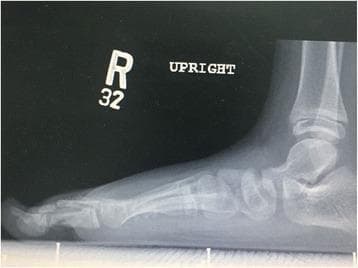 This lateral weight-bearing (upright) X-ray of the right foot demonstrates a severe flat-foot deformity (pes planus). There is a significant collapse of the medial longitudinal arch, characterized by the plantarflexion of the talus and the loss of the normal angular relationship between the talus and the first metatarsal. The calcaneus, talus, and midtarsal bones appear to be in a linear, flattened alignment relative to the weight-bearing surface. The metatarsals and phalanges are long and slender, suggesting arachnodactyly, which is consistent with connective tissue disorders like Van den Ende-Gupta syndrome (VDEGS). The presence of open growth plates at the distal tibia and fibula indicates a pediatric or adolescent patient. No acute fractures or dislocations are visualized, but the structural alignment indicates significant ligamentous laxity or bony architectural compromise contributing to the arch collapse.