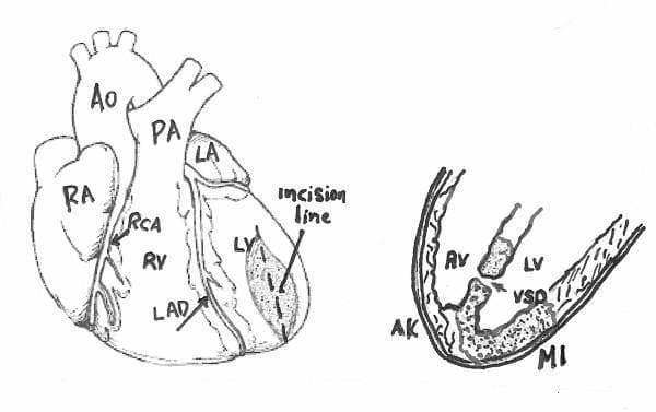 This medical illustration consists of two diagrams depicting cardiac anatomy and pathology associated with myocardial infarction and surgical intervention. The left panel shows an anterior view of the heart with major structures labeled: Right Atrium (RA), Right Ventricle (RV), Left Atrium (LA), Left Ventricle (LV), Aorta (Ao), and Pulmonary Artery (PA). The coronary vasculature is highlighted, specifically the Right Coronary Artery (RCA) and Left Anterior Descending (LAD) artery. An 'incision line' is indicated on the apex of the left ventricle over a shaded area representing infarcted tissue. The right panel is a cross-sectional diagram focusing on the ventricular chambers. It illustrates a Ventricular Septal Defect (VSD), which is a communication between the left and right ventricles. Also labeled are the Aortic Valve (AV), an area of Myocardial Infarction (MI) in the ventricular wall, and adjacent Akinetic (AK) tissue. The illustration serves to demonstrate the anatomical location for a ventriculotomy used to repair post-infarction ventricular septal rupture.