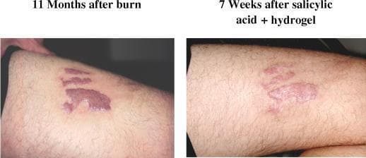 This clinical photograph represents a comparison of a hypertrophic burn scar on the medial thigh of a 42-year-old male before and after treatment. The left panel, labeled '11 Months after burn', shows a well-demarcated, elevated, and intensely erythematous (reddish-purple) scar with irregular borders, characteristic of hypertrophic scarring following a deep partial-thickness or full-thickness burn. The right panel, labeled '7 Weeks after salicylic acid + hydrogel', demonstrates the clinical progression after topical intervention. There is a visible reduction in erythema, with the scar tissue appearing lighter and more pinkish. The lesion also shows a noticeable decrease in vertical height (elevation) and thickness compared to the baseline image. The surrounding skin appears less inflamed, and the overall morphology of the scar is more flattened and less prominent. This comparison illustrates the therapeutic efficacy of combining salicylic acid and hydrogel in managing the physical and vascular characteristics of chronic hypertrophic scars in dermatology and burn surgery.