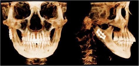 This diagnostic image consists of two 3D-Cone Beam Computed Tomography (CBCT) volume renderings of a human skull, showing frontal (left) and right lateral (right) views. The scans demonstrate the outcome of a right-sided subcondylar mandibular fracture management eight months postoperatively. Internal fixation hardware is visible in the right subcondylar region, consisting of two miniplates and associated monocortical/bicortical screws. In the lateral view, the plates are oriented along the posterior and anterior aspects of the subcondylar neck. Notable surgical changes include a bilateral mandibular angle ostectomy (angle reduction). The condylar fragment appears stable and well-aligned with the mandibular ramus, exhibiting no significant displacement or malunion despite the presence of fixation hardware. The anatomical focus is the maxillofacial region, specifically the temporomandibular joint (TMJ) area and the mandibular ramus, relevant for oral and maxillofacial surgery education regarding trauma and orthognathic procedures.
