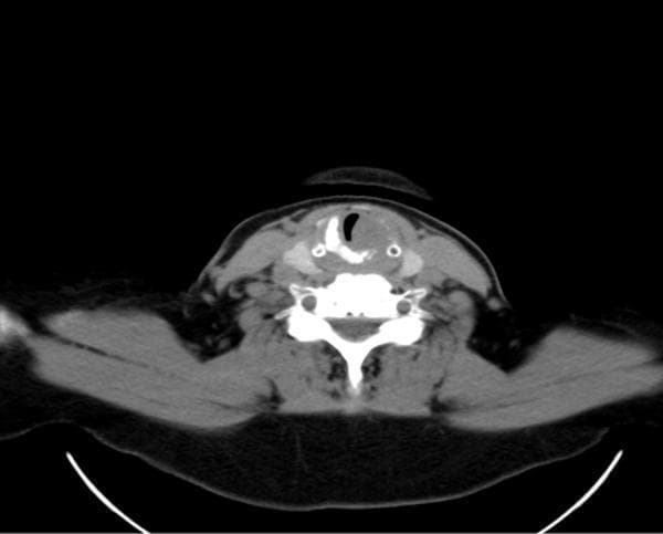 This diagnostic image is an axial contrast-enhanced CT scan of the neck at the level of the larynx. The image demonstrates a significant soft-tissue nodular lesion originating from the left glottic and subglottic region. A hallmark of this pathology is the visible partial destruction and infiltration of the left thyroid cartilage, along with suspected involvement of the cricoid ring and ipsilateral arytenoid cartilage. The mass results in substantial narrowing and displacement of the laryngeal airway lumen toward the right. Adjacent soft tissue structures show bilateral cervical lymph node hyperplasia. This visual evidence is characteristic of an invasive laryngeal neoplasm, such as adenoid cystic carcinoma, highlighting the clinical significance of CT in assessing cartilage invasion and airway compromise for surgical planning. The scan is a key educational resource for identifying laryngeal anatomy, cartilage landmarks, and signs of malignant infiltration in head and neck oncology.