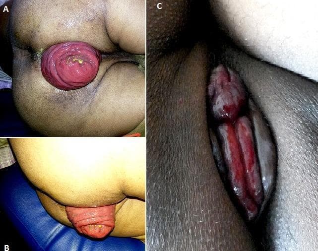 This composite of three clinical photographs provides a visual comparison between full-thickness rectal prolapse and prolapsed internal hemorrhoids, serving as an educational tool for proctological diagnosis. Panel A (posterior view) and Panel B (lateral view) demonstrate a complete rectal prolapse. The images show a large, reddish-pink, cylindrical mass protruding from the anal canal. A pathognomonic feature is the presence of concentric, circular mucosal folds, which distinguish it from other pathologies. Panel C depicts prolapsed internal hemorrhoids. This view shows three distinct, elongated, reddish-purple masses arranged radially within the anal region. Unlike the rectal prolapse in A and B, these masses demonstrate longitudinal or radial folds and are separated by grooves, corresponding to the left lateral, right anterolateral, and right posterolateral anatomical positions. Some surface moisture and vascular congestion are visible. This clinical imagery is essential for differentiating pelvic floor disorders and anorectal conditions based on fold orientation and morphology.