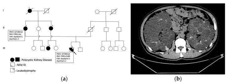 This composite educational figure illustrates the clinical and genetic presentation of Autosomal Dominant Polycystic Kidney Disease (ADPKD). Part (a) displays a multi-generational pedigree chart (family tree) demonstrating the autosomal dominant inheritance pattern of PKD. Black filled icons indicate family members affected by the disease; the proband is marked with an arrow and further labeled with specific genetic findings including PKD1 and PAH variants, and chromosomal microduplications. Part (b) is an axial non-contrast computed tomography (CT) scan of the abdomen. The image shows massive bilateral nephromegaly (enlarged kidneys) that occupy a significant portion of the abdominal cavity. The renal parenchyma is extensively replaced by numerous cystic formations. Several of these cysts exhibit hyperdense signals, which may suggest intracystic hemorrhage or high protein content. Additionally, multiple small cysts are visible within the liver parenchyma, consistent with a multi-organ manifestation of the disease. The image provides clinical evidence of severe polycystic changes in a patient with a family history of renal failure.