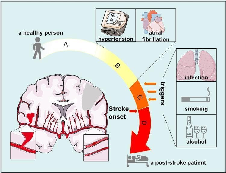 Educational pathophysiology diagram illustrating the progression from a healthy state to post-stroke status across four stages (A-D). Stage A represents a healthy individual with no chronic disease. Stage B depicts the accumulation of chronic risk factors, specifically hypertension (shown with a blood pressure monitor reading 160/90) and atrial fibrillation (illustrated by a heart diagram). Stage C describes a 'stroke-prone status' where external acute triggers, represented by icons for lung infection, smoking, and alcohol consumption, act upon existing risk factors. The final stage D represents the post-stroke state, symbolized by a patient in a hospital bed. Central to the diagram is a coronal cross-section of the human brain showing pathological changes: the right hemisphere contains a gray ischemic or infarcted area, and the left hemisphere depicts a hemorrhagic event. Zoomed insets highlight vascular pathologies, including a vessel rupture with active bleeding and an intraluminal thrombus or embolism. This infographic serves as a conceptual model for stroke risk accumulation and the transition from chronic pathology to acute cerebrovascular events.