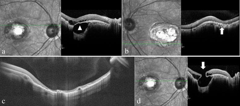 This composite diagnostic image displays multiple infrared fundus photographs and corresponding spectral-domain optical coherence tomography (SD-OCT) scans of patients with North Carolina Macular Dystrophy (NCMD), specifically illustrating Grade 3 'macular caldera' lesions. Panel (a) shows significant choroidal atrophy at the lesion edge with relative preservation of the overlying neurosensory retina and retinal pigment epithelium (RPE), marked by an arrowhead. Panel (b) illustrates localized RPE atrophy at the lesion periphery where the choroid remains largely intact (arrow). Panel (c) provides a wide-field OCT view of a deep macular excavation, highlighting the thinning and potential loss of the RPE and outer retinal layers, though some neurosensory tissue remains as a thin covering over the lesion floor. Panel (d) demonstrates a significant structural complication: a full-thickness macular hole (arrow) overlying a deep coloboma-like excavated area. These scans highlight the phenotypic variability of NCMD, emphasizing the differential atrophy patterns of the retinal layers, RPE, and choroid in advanced stages of the disease.