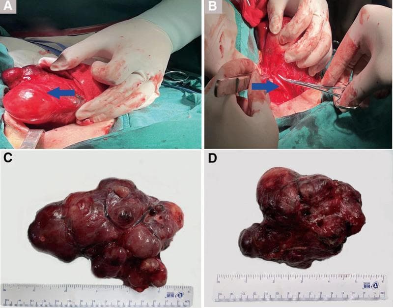 A composite clinical photograph documenting a total thyroidectomy for a giant goiter. Panel A shows an intraoperative view of the lateral dissection of the right thyroid lobe, exhibiting significant glandular hypertrophy and vascular congestion. Panel B displays the surgical field with a blue arrow identifying the recurrent laryngeal nerve (RLN) in the right tracheoesophageal groove, preserved during dissection. Panels C and D present the gross macroscopic appearance of the resected specimens against a white background with a centimeter scale. Panel C shows the resected right lobe and isthmus (12 x 7 x 5 cm), characterized by a multinodular, lobulated surface with prominent venous congestion and varied reddish-brown coloration. Panel D shows the resected left lobe (12 x 9 x 6 cm), which is similarly enlarged with a nodular texture and dense vascular appearance. The image illustrates surgical anatomy and the gross pathology of multinodular goiter, highlighting the importance of nerve identification during radical neck surgery.
