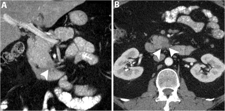 This diagnostic image consists of two panels: (A) a coronal and (B) an axial contrast-enhanced CT scan in the pancreatic phase, focused on the abdominal cavity. The images demonstrate a small, subtle hypoattenuating mass located within the uncinate process of the pancreas, highlighted by white arrowheads. Notably, despite the presence of this focal lesion, there is a distinct absence of secondary signs typically associated with pancreatic ductal adenocarcinoma (PDAC), such as dilatation of the common bile duct (CBD) or the main pancreatic duct (MPD). The overall morphology of the pancreatic head, body, and tail appears otherwise unremarkable with preserved parenchymal enhancement. This case illustrates a diagnostic challenge in early-stage uncinate process PDAC, where the tumor's specific anatomical location prevents biliary or pancreatic ductal obstruction, potentially delaying detection. Such findings are critical for radiologists and oncology specialists to recognize as 'subtle' pancreatic masses during routine or targeted abdominal imaging.