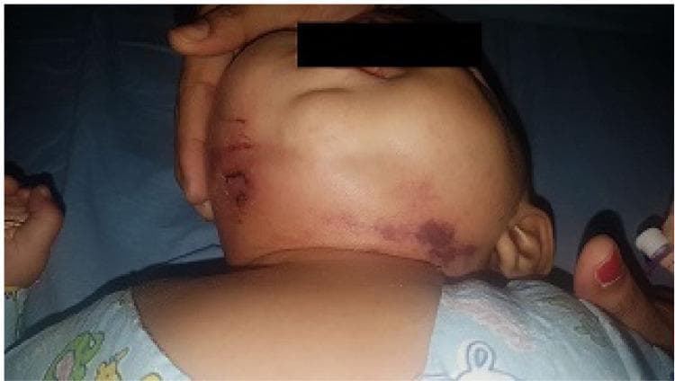 This clinical photograph displays a six-month-old female infant with a severe presentation of Ludwig's angina. The image shows significant, diffuse swelling (cellulitis) involving the submandibular and submental regions, extending toward the right side of the face and neck. Notable skin findings include prominent ecchymosis and dark purple discoloration on the right side of the neck, suggesting vascular congestion or tissue ischemia. Linear abrasions and skin lesions are visible on the left lateral aspect of the face near the ear. The infant's face appears flushed, indicating acute inflammation. This case represents a rare pediatric manifestation of Ludwig's angina, which is typically characterized by rapidly spreading cellulitis of the floor of the mouth and submandibular space. The image highlights the critical need for monitoring airway patency in pediatric patients with progressive submandibular swelling.