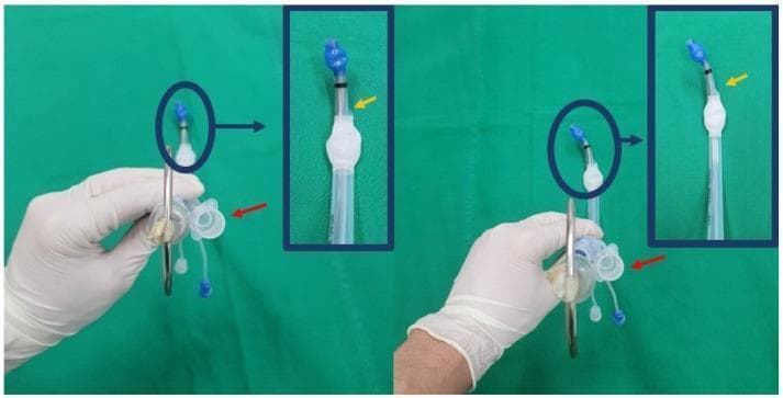 Clinical photograph demonstrating the orientation of a left-sided double-lumen endotracheal tube (DLT) with a customized J-shaped stylet, illustrating the non-rotatory maneuver technique for intubation. The image is split into two panels (initial setup on the left, insertion state on the right) with magnified insets of the distal tip. The bronchial lumen is oriented to the left, while the tracheal lumen's proximal orifice (indicated by a red arrow) and distal orifice (indicated by a yellow arrow in the insets) are oriented to the right side. The distal tip features a blue-colored cuff connected to the clear main body of the silicone tube. The right panel demonstrates how the tube maintains its orientation during the non-rotatory maneuver, with a slight adjustment in the curvature of the stylet's tip relative to the main axis. This visual provides clinical guidance on DLT positioning to facilitate faster intubation and minimize mucosal trauma compared to conventional rotatory techniques.