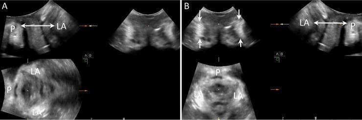 This diagnostic ultrasound image utilizes multiplanar mode (MP mode) to display the normal anatomy of the female pelvic floor across three orthogonal planes: midsagittal, coronal, and axial. The image is divided into panels A and B, illustrating the methodology for assessing the levator ani (LA) muscle and its insertion point on the pubic symphysis (P). In the midsagittal plane (top left of panel A; top right of panel B), a double-sided arrow indicates the minimal anteroposterior (AP) diameter, which serves as a reference for the minimal axial plane. The coronal plane (top left of panel B) highlights the levator ani muscles as symmetrical, crescent-shaped hyperechogenic structures (indicated by white arrows). In the axial plane (bottom left), the relationship between the levator ani and the pubic symphysis is visualized, showing the intact U-shaped morphology of the pelvic floor muscles. This imaging technique is critical in urogynecology for diagnosing levator ani muscle injuries (LAMI) or avulsions, which are key risk factors for pelvic organ prolapse (POP).