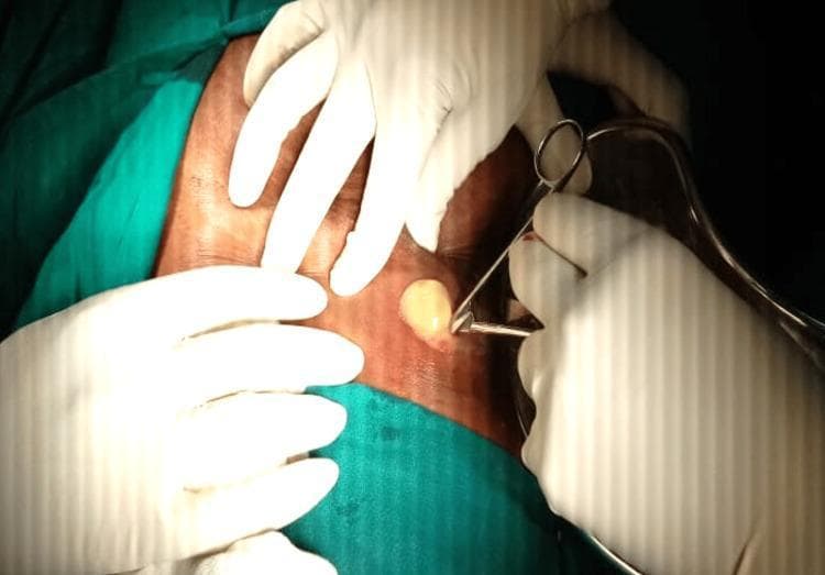 This clinical photograph captures a surgical incision and drainage (I&D) procedure of a subcutaneous abscess. The image focuses on a small, transverse incision made in the right hypochondriac region of the abdomen. Thick, opaque, yellowish purulent material (pus) is visible emerging from the opening, indicating an active infectious process. Several hands clad in sterile white surgical gloves are positioned around the site; one set of hands applies pressure to the surrounding skin to facilitate drainage, while another hand holds a surgical instrument, likely a hemostat or forceps, to keep the incision edges open. The surgical field is prepared with green sterile drapes, and the surrounding skin appears erythematous and taut. This visual demonstrates the management of a liver abscess with parietal extension, illustrating key steps in bedside or operating room drainage of localized collections. It serves as an educational example for general surgery and infectious disease specialties, highlighting the physical characteristics of purulent exudate and basic surgical technique.