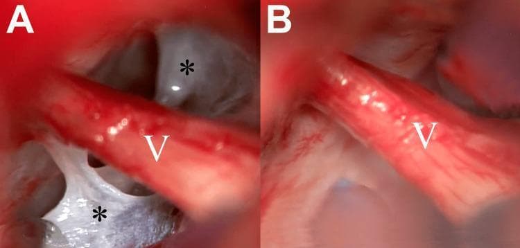 Intraoperative microscopic photographs illustrating microvascular decompression (MVD) surgery in the left cerebellopontine angle for trigeminal neuralgia. Image A shows the trigeminal nerve (labeled V) partially obscured by thickened, opaque, and web-like arachnoid membranes (indicated by asterisks). These pathological membranes are seen adhering to the nerve root and adjacent neurovascular structures, potentially contributing to nerve irritation or compression through arachnoiditis. Image B displays the same surgical field following the meticulous removal of the thickened arachnoid tissue. This neurolysis achieves 'release' of the nerve, providing a clear, unobstructed view of the trigeminal nerve root and allowing for definitive exploration of any underlying neurovascular conflict. The comparison highlights the clinical importance of arachnoid dissection in posterior fossa functional neurosurgery to ensure adequate nerve decompression and visualization.