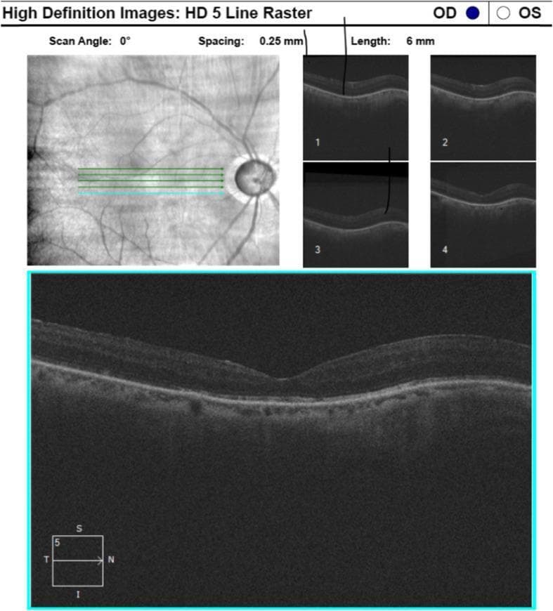 An Optical Coherence Tomography (OCT) report showing a macula scan of the right eye (OD). The visual displays a fundus infrared reflectance image with 5-line raster scan lines and corresponding cross-sectional B-scans. The primary B-scan shows a normal anatomical contour with a preserved foveal depression and intact retinal layers. The inner retinal layers exhibit uniform reflectivity, while the retinal pigment epithelium (RPE) appears as a distinct, hyperreflective band. No evidence of intraretinal or subretinal fluid, macular edema, or subretinal deposits is visible. The underlying choroid is visible and appears relatively thin (consistent with age-related changes or baseline physiology), showing no abnormal vascular formations or elevations. The orientation markers (Superior, Inferior, Temporal, Nasal) indicate the scan covers the temporal-nasal axis through the fovea.