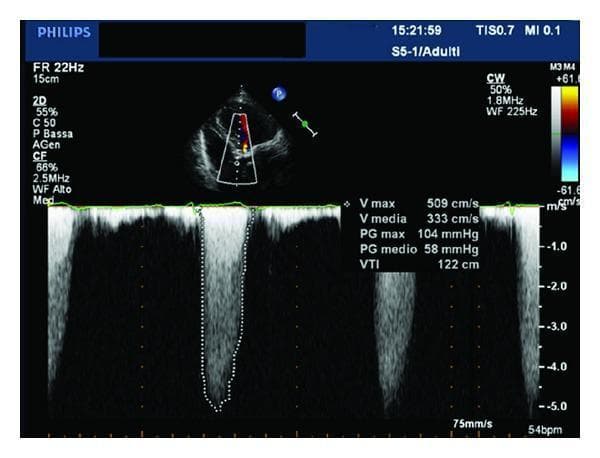 Transthoracic echocardiogram (TTE) image demonstrating severe aortic valve stenosis. The upper panel shows a 2D sector view with color Doppler mapping over the aortic valve, highlighting turbulent high-velocity flow. The lower panel displays a Continuous Wave (CW) spectral Doppler waveform obtained at 1.8MHz. Hemodynamic measurements indicate severe stenosis: a peak velocity (V max) of 509 cm/s, a mean velocity (V media) of 333 cm/s, a peak pressure gradient (PG max) of 104 mmHg, and a mean pressure gradient (PG medio) of 58 mmHg. The Velocity Time Integral (VTI) is recorded at 122 cm. Technical settings include a sweep speed of 75mm/s and a heart rate of 54 bpm. This diagnostic image illustrates the quantification of valvular obstruction through spectral Doppler analysis, essential for grading the severity of calcific or degenerative aortic valve disease in clinical cardiology.