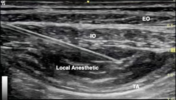 This diagnostic ultrasound image demonstrates a transversus abdominis plane (TAP) block procedure. The image depicts the layered anatomy of the lateral abdominal wall, showing three distinct muscle layers from superficial to deep: the external oblique (EO), internal oblique (IO), and transversus abdominis (TA) muscles. A hyperechoic, linear needle is visible entering from the left at an oblique angle, with its tip precisely positioned in the fascial plane between the IO and TA muscles. An anechoic to hypoechoic area is labeled 'Local Anesthetic,' showing the characteristic hydrodissection and separation of the IO and TA muscle layers as the fluid expands the potential space. This visual serves as a primary educational tool for regional anesthesia, illustrating real-time needle guidance and successful fascial plane infiltration for postoperative pain management. The image includes depth markers on the right and standard anatomical labels, making it suitable for training in ultrasound-guided nerve blocks.