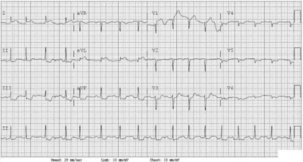 A diagnostic 12-lead electrocardiogram (ECG) displayed on a standard grid (25 mm/sec speed; limb 10 mm/mV, chest 20 mm/mV) demonstrating an inferolateral ST-segment elevation myocardial infarction (STEMI). The layout includes limb leads (I, II, III, aVR, aVL, aVF) and precordial leads (V1-V6), with a long Lead II rhythm strip at the bottom. Significant pathology is observed in the inferior leads (II, III, and aVF), which show marked ST-segment elevation. Additionally, lateral leads (V4-V6) exhibit ST-segment changes consistent with an extending infarct. Reciprocal ST-segment depression is present in the high lateral leads (I, aVL) and precordial leads V1-V3, further confirming the diagnostic pattern of an acute inferior wall STEMI. The ECG is essential for emergency department triage and rapid diagnosis of acute coronary syndrome (ACS) in clinical settings.