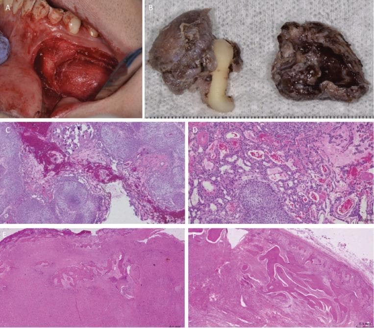 A composite image illustrating the intraoperative, macroscopic, and microscopic characteristics of an adenomatoid odontogenic tumor (AOT). Frame A is an intraoperative clinical photograph of the mandible showing a reddish, well-circumscribed mass exposed after a vestibular flap. Frame B shows the gross surgical specimen consisting of a brownish cystic capsule surrounding an impacted canine tooth and a separate thick-walled cystic fragment. Frames C-F are light microscopy images stained with Hematoxylin and Eosin (H&E). Micrographs C and D (20x magnification) demonstrate a biphasic odontogenic epithelial proliferation characterized by spindle-shaped cells arranged in solid nodules, whorled patterns, and characteristic duct-like structures with eosinophilic luminal material. Micrographs E and F show a different component of the lesion consisting of dense fibroblastic connective tissue proliferation containing irregular, mineralized bone-like or cementum-like trabeculae. The image illustrates the classic histopathological features of a hybrid odontogenic lesion, combining features of AOT with calcifying epithelial structures.
