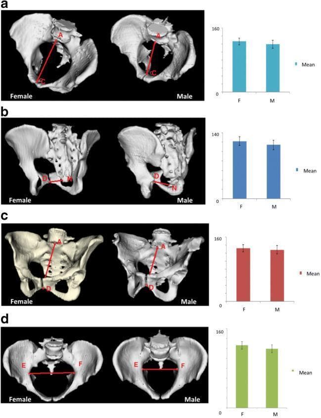 This medical comparison chart utilizes 3D reconstructions and statistical bar graphs to illustrate sexual dimorphism in pelvic inlet measurements between females and males. The content is divided into four sections (a-d), each showcasing a different clinical pelvimetry parameter. Section (a) demonstrates the obstetric conjugate (A-C), showing a greater anteroposterior dimension and a more rounded inlet in the female pelvis. Section (b) displays the true conjugate (D-M), while section (c) shows the diagonal conjugate (A-D), both highlighting the increased pelvic capacity in females. Section (d) visualizes the transverse diameter (E-F), emphasizing the broader, more oval shape of the female pelvic brim compared to the narrower, heart-shaped male inlet. Accompanying bar charts provide quantitative mean differences, confirming that these inlet diameters are significantly larger in the female population. This resource is designed for anatomy and obstetrics education, focusing on the structural adaptations of the female pelvis for childbirth and its comparative morphology against the male pelvis.