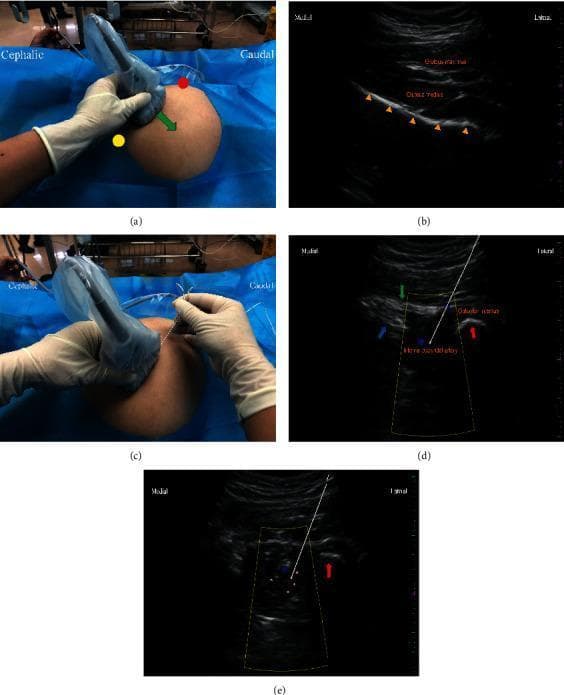 This composite figure illustrates the procedural steps and ultrasonographic anatomy for an ultrasound-guided pudendal nerve block (PNB) at the level of the ischial spine. Panel (a) shows the initial transducer placement between the greater trochanter and posterior superior iliac spine. Panel (b) is a gray-scale ultrasound image identifying the iliac bone as a continuous, hyperechoic specular reflector. Panel (c) depicts the lateral-to-medial in-plane needle insertion technique. Panel (d) shows the sonographic landmarks at the lesser sciatic notch, including the sacrospinous ligament (medial), sacrotuberous ligament (superficial), and ischial tuberosity (lateral). Color Doppler identifies the internal pudendal artery within the Alcock (pudendal) canal, situated in the acute angle between the coccygeus and internal obturator muscles. Panel (e) demonstrates the post-injection state, showing the hypoechoic spread of local anesthetic around the neurovascular bundle. This series serves as a clinical guide for anesthesiologists to achieve regional anesthesia for perineal procedures such as hemorrhoidectomy.