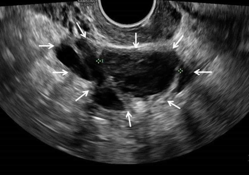 This diagnostic image is a transvaginal ultrasound scan of the female pelvis focusing on the right adnexa. It demonstrates a right ovarian cyst, approximately 3.5 cm in size, highlighted by multiple white arrows. The lesion presents as a complex cystic structure with mixed echogenicity. Key visual features include well-defined but irregular borders and a heterogeneous internal composition characterized by low-level internal echoes and thin, stringy internal septations. These fine, hyperechoic strands cross the primarily hypoechoic fluid-filled space, creating a multi-loculated appearance typical of complex cysts. In the provided clinical context, these findings are consistent with an evolving ovarian dermoid cyst (mature cystic teratoma) or a hemorrhagic cyst. The image serves as an educational example of pelvic sonography used to differentiate simple fluid-filled follicles from complex adnexal masses based on internal architecture and echotexture.