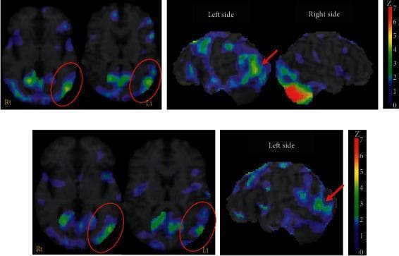 This diagnostic image displays 123I-IMP Single Photon Emission Computed Tomography (SPECT) perfusion scans of the brain, comparing findings from day 98 (top row) to three years after stroke onset (bottom row). The scans utilize Z-score mapping against a normal database to identify areas of significant hypoperfusion, with the color scale ranging from blue (Z=0) to red (Z=7). Significant hypoperfusion (Z > 2.0) is highlighted in green, yellow, and red. Axial slices and lateral surface projections demonstrate a marked area of decreased perfusion in the left posterior middle frontal and temporal gyri, indicated by red circles and arrows. Additionally, the right cerebellar hemisphere shows significant hypoperfusion, consistent with the site of a known infarction. The follow-up scan at three years demonstrates a visual attenuation of these deficits, showing a reduction in both the spatial extent and the intensity (Z-score magnitude) of the hypoperfusion in the left cerebral cortex. This longitudinal comparison illustrates the evolution of crossed cerebellar-cerebral diaschisis and regional perfusion recovery over time.