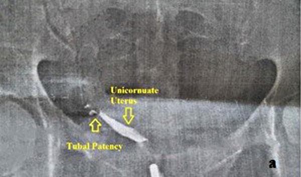 This diagnostic image is a hysterosalpingogram (HSG), a radiographic study using radiopaque contrast material to evaluate the female reproductive tract. The image demonstrates a unicornuate uterus (Class II Mullerian duct anomaly), characterized by a single, narrow, elongated uterine cavity directed toward one side of the pelvis (unilateral cornual development). A single fallopian tube is visualized extending from the horn, with the presence of contrast spill into the peritoneal cavity, indicating tubal patency on the functional side. There is a complete absence of the contralateral uterine horn and fallopian tube. The bony pelvic anatomy, including the iliac wings and femoral heads, serves as the anatomical background. This imaging is clinically significant for diagnosing congenital uterine anomalies in patients presenting with infertility or recurrent pregnancy loss. Key educational concepts include Mullerian duct malformations, HSG interpretation, and assessment of tubal patency.