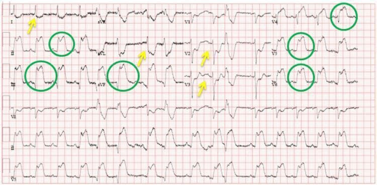 A standard 12-lead electrocardiogram (ECG) displayed on a red-grid background, illustrating an acute inferolateral ST-elevation myocardial infarction (STEMI). The tracing exhibits significant ST-segment elevations (marked with green circles) in the inferior leads (II, III, and aVF) and the lateral precordial leads (V4, V5, and V6). Concurrent reciprocal ST-segment depressions (marked with yellow arrows) are visible in the high lateral leads (I and aVL) and the anterior precordial leads (V2 and V3). The ECG is organized in a standard layout with limb leads I-III and aVR-aVF on the left and precordial leads V1-V6 on the right, with a continuous rhythm strip at the bottom. This diagnostic image demonstrates the classic electrical patterns of acute myocardial ischemia and infarction, specifically targeting the inferolateral wall of the left ventricle. It serves as a critical educational tool for identifying ST-segment morphology changes and reciprocal electrical deviations in emergency cardiovascular medicine.