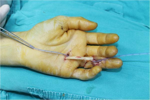 This clinical photograph demonstrates an intraoperative view of a flexor tendon repair in the hand. The patient's hand is shown in a supine position, prepared with a yellow-tinted antiseptic solution. Two surgical incisions are visible on the index finger: a proximal incision at the distal palmar crease near the metacarpophalangeal joint and a distal incision at the level of the distal interphalangeal joint. A blue-tinted 8-French (F) suction catheter is used as a conduit, passing through the tendon sheath tunnel. The proximal end of a retracted flexor tendon has been delivered through the palmar incision and is held by a 3-0 polypropylene half-modified Kessler suture, which is being threaded through the catheter. The surgical field highlights the technique for retrieving a retracted tendon and bypassing the pulley system without causing further trauma to the sheath. Forceps are used to guide the catheter and suture. The image serves as a pedagogical resource for orthopedic and hand surgeons regarding tendon reconstruction and suturing techniques.
