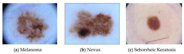This set of three clinical dermoscopy images provides a comparative visual analysis of common skin lesions: (a) melanoma, (b) nevus, and (c) seborrheic keratosis. The melanoma image demonstrates classic ABCDE criteria, including asymmetry and irregular, notched borders with variegated pigmentation ranging from light tan to dark brown. The nevus displays a somewhat irregular but more uniform brown pigment network, though it contains a concentrated area of darker melanocytic activity. In contrast, the seborrheic keratosis presents as a well-circumscribed, more symmetrical, and uniformly dark brown plaque-like lesion with a characteristic 'stuck-on' appearance common in non-melanocytic epidermal tumors. All three images are captured under high-magnification dermoscopy to highlight surface patterns and pigment distribution. A measuring scale is visible in the seborrheic keratosis frame for size estimation. These images serve as educational benchmarks for differentiating malignant melanoma from benign melanocytic nevi and non-melanocytic keratinocytic lesions in dermatology and oncology curricula.
