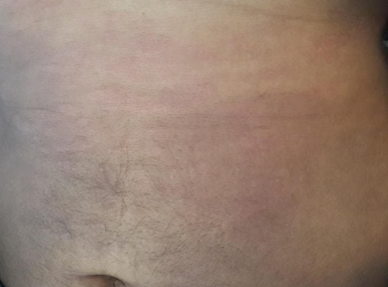 This clinical photograph shows the abdominal region of a 31-year-old male exhibiting a classic cutaneous manifestation of Adult-onset Still's disease (AOSD). The image demonstrates a faint, salmon-pink (rose-salmon) maculopapular rash. The lesions consist of small, non-confluent macules and slightly raised papules with indistinct borders, distributed across the trunk and peri-umbilical area. The rash is characteristically evanescent, often coinciding with febrile peaks. Key clinical features include the subtle coloration and the diffuse, non-scaling texture of the eruption. This visual is an essential diagnostic reference for rheumatology and dermatology, illustrating one of the major Yamaguchi criteria for AOSD. The clinical context involves a patient with systemic inflammatory symptoms, including high-grade fever, polyarthritis, and significantly elevated ferritin levels, where this specific dermatological finding helps differentiate AOSD from other systemic inflammatory or infectious diseases.
