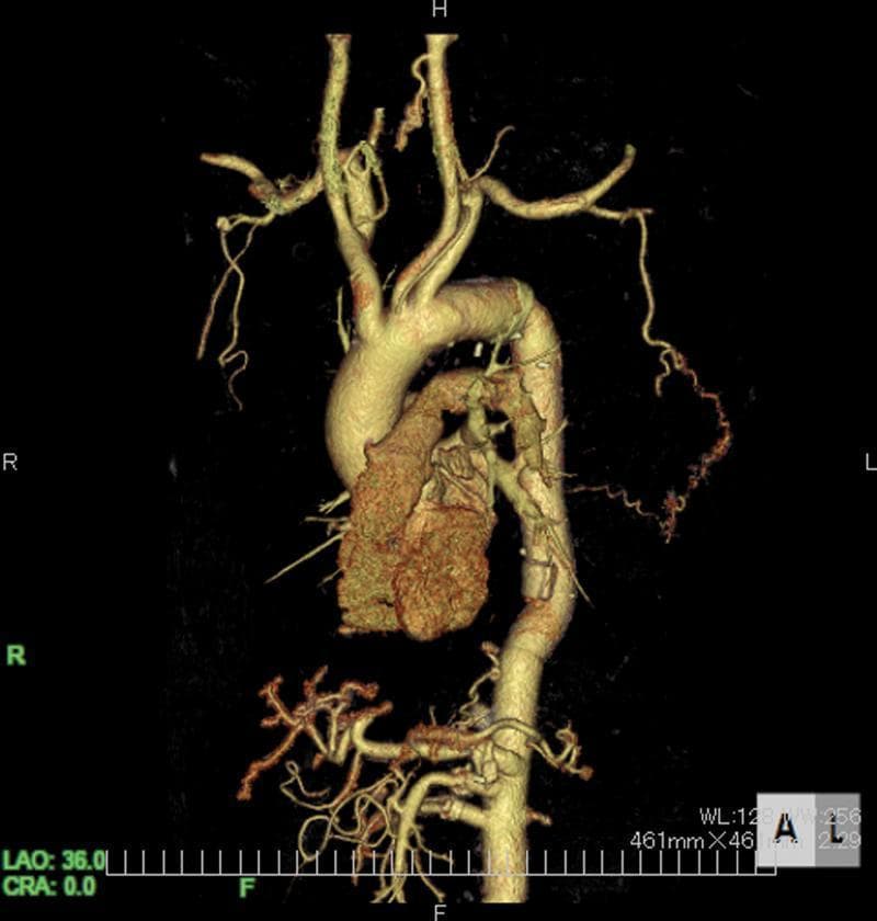 This diagnostic image is a 3D-reconstructed computed tomography angiography (CTA) showing the human thoracic and abdominal aorta in a postoperative state. The aortic arch is prominently visualized with its primary branches, including the brachiocephalic trunk, left common carotid, and left subclavian arteries. The heart is positioned anteriorly to the descending aorta. A critical finding is the presence of a tortuous collateral vessel originating from the left lateral thoracic artery. This collateral pathway extends medially and inferiorly to provide retrograde blood supply to the artery of Adamkiewicz (AKA), serving as a vital compensatory mechanism following the occlusion of reconstructed intercostal arteries. The image highlights the vascular anatomy relevant to spinal cord perfusion and the clinical significance of preserving extra-anatomical collateral circulation during complex aortic surgeries to prevent neurological complications such as paraplegia. The reconstruction demonstrates the vessel's patency and winding morphology against the surrounding vascular structures.