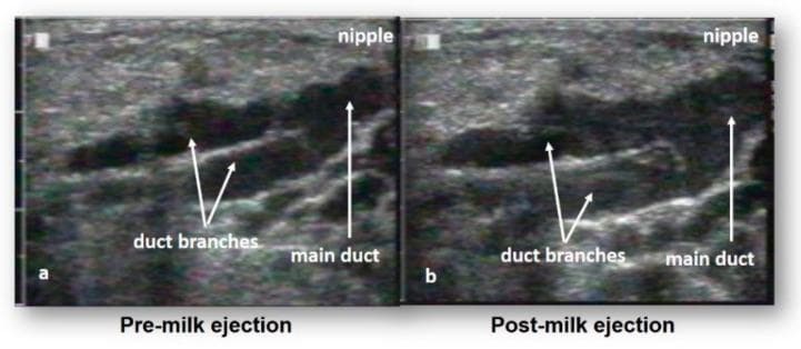 This diagnostic image consists of two side-by-side ultrasound frames (a and b) illustrating the functional anatomy of the lactating human breast during the milk ejection reflex. The imaging modality is B-mode ultrasound, used to visualize the mammary ductal system in real-time. In both images, the milk ducts are identified as prominent anechoic (black) tubular structures, providing high contrast against the surrounding hyperechoic, granular connective and adipose tissue. Figure (a), labeled 'Pre-milk ejection', shows the main duct and duct branches in a relatively narrow state. Figure (b), labeled 'Post-milk ejection', demonstrates significant ductal expansion and distention due to the presence of breast milk following the ejection reflex. Annotated labels indicate the 'nipple' position at the top right, with arrows highlighting the 'main duct' and 'duct branches'. This comparison serves as educational material to demonstrate that mammary ducts function primarily as transport vessels that dilate during milk flow rather than serving as large static storage reservoirs, contributing to contemporary understanding of breastfeeding physiology and mammary gland function.