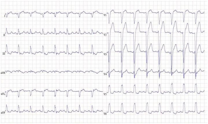This diagnostic image is a 12-lead electrocardiogram (ECG) demonstrating a sinus rhythm with features characteristic of a Right Bundle Branch Block (RBBB). The ECG shows regular P waves preceding each QRS complex, indicating a sinus origin. The key diagnostic finding is the marked widening of the QRS complex (>120 ms). In the precordial leads V1 through V3, there are prominent, broad, and notched monophasic R waves (Rsr' pattern), which are classic indicators of delayed right ventricular depolarization. Leads V5 and V6 demonstrate slurred S waves. Secondary repolarization abnormalities, including T-wave inversion and ST-segment depression, are visible in the right precordial leads (V1-V3), which are common discordant changes in the setting of a bundle branch block. This tracing is an educational example of intraventricular conduction delay used to teach cardiac electrophysiology and the interpretation of morphological changes in ventricular depolarization.