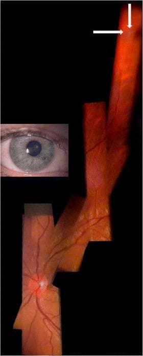 This diagnostic visual is a composite digital fundus mosaic of a right eye, created by stitching six slit-lamp video frames together. The image demonstrates clinical features of ocular sarcoidosis, specifically highlighting peripheral pre-retinal 'snowballs.'
The main visualization shows the optic disc and retinal vasculature extending into the periphery. In the far superior-peripheral retina, white arrows indicate small, discrete, whitish-bright lesions—vitreous opacities known as snowballs—which are characteristic of intermediate uveitis. These lesions exhibit a raised or opaque quality, evidenced by adjacent shadows cast onto the underlying fundus. The composite illustrates the topographical relationship between the central optic nerve and far-peripheral inflammatory findings.
An inset photograph of the anterior segment shows a narrow, undialated pupil, demonstrating that the fundus examination and videography were performed through a small aperture using a slit lamp and a +90D lens at 12x magnification. This imaging technique provides an alternative for capturing peripheral retinal pathology when full mydriasis is absent or clinically challenging.