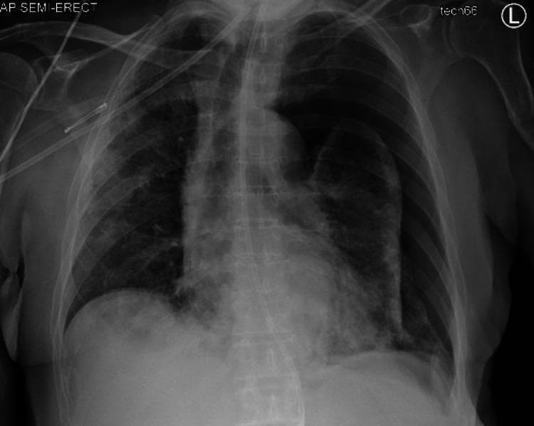 This anteroposterior (AP) semi-erect chest X-ray illustrates a significant secondary spontaneous pneumothorax in the left hemithorax. The image reveals a large, radiolucent space in the left pleural cavity with a complete absence of bronchovascular lung markings, characteristic of a pneumothorax. The left lung is partially collapsed and appears denser as it is displaced medially toward the hilum. Key diagnostic findings include a subtle tracheal deviation to the right and a corresponding mediastinal shift, indicating a degree of tension effect. The right lung field demonstrates multifocal opacities, which in the clinical context of COVID-19, are suggestive of underlying pneumonia or pulmonary edema. The costophrenic angles are visible, and medical monitoring lines are present. This diagnostic image is an educational example of acute pleural pathology and its mechanical effects on thoracic midline structures, suitable for medical students and radiology residents studying respiratory emergencies.
