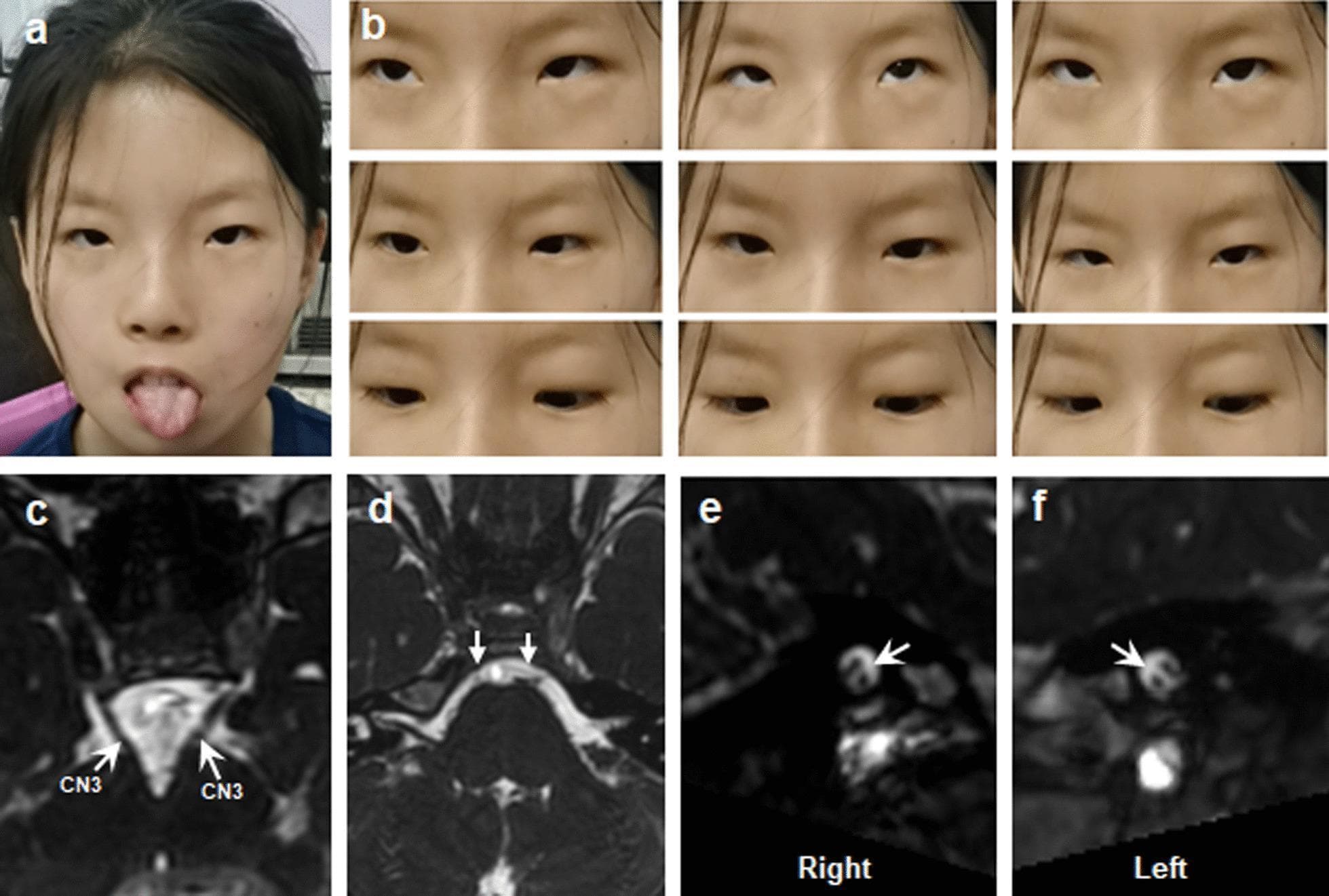 This composite educational graphic illustrates the clinical and radiological hallmarks of Moebius Syndrome (MBS). Panel (a) is a clinical photograph of a young patient demonstrating bilateral congenital facial weakness, characterized by a masked facies and hypoplasia of the tongue upon protrusion. Panel (b) consists of a nine-gaze photograph series showing significant limitations in horizontal eye movements, consistent with abducens nerve palsy. Panels (c–f) present T2-weighted cranial MRI sections focused on the brainstem. White arrows in panel (c) identify normal appearances of the oculomotor nerves (CN3). In contrast, panels (d–f) demonstrate hypoplasia of the bilateral abducens (CN6) and facial (CN7) nerves, visible as significantly reduced or absent neural signals at their respective brainstem exit zones. This figure serves as a diagnostic reference for Congenital Cranial Dysinnervation Disorders (CCDDs), correlating external physical signs like facial paralysis and restricted motility with neuroanatomical deficits of the cranial nerves.