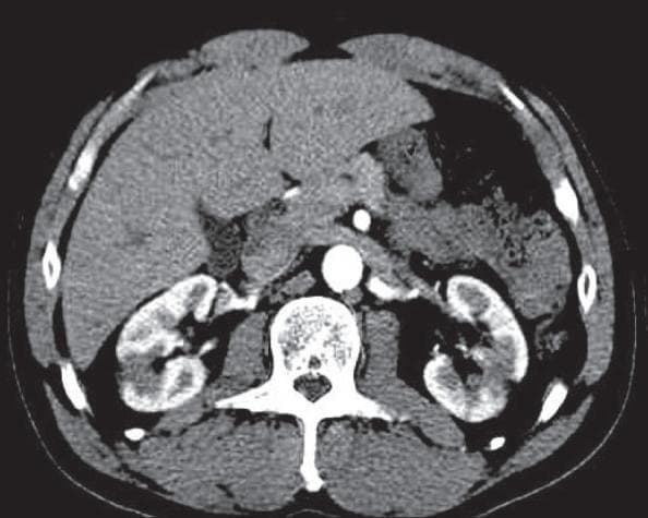 This diagnostic image is an axial contrast-enhanced computerized tomography (CT) scan of the abdomen at the level of the kidneys. The image demonstrates bilateral renal enlargement, characteristic of an inflammatory process. The renal parenchyma exhibits a classic 'striated nephrogram' pattern, defined by alternating linear or streaky areas of decreased attenuation (hypodensities) and normal contrast enhancement. Additionally, there is evidence of minimal perinephric fat stranding, indicating localized inflammation in the surrounding retroperitoneal space. Other visible anatomical structures include the liver, abdominal aorta, and lumbar vertebrae. These visual findings are highly suggestive of acute pyelonephritis. This material is suitable for medical education focusing on uroradiology and the diagnostic features of renal infections.