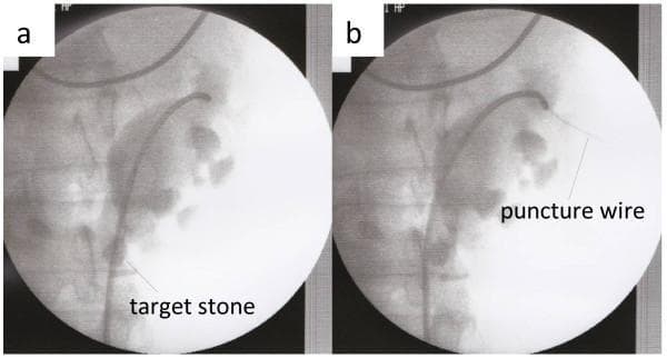 This diagnostic image pair displays retrograde pyelography of a human kidney, specifically within the context of a percutaneous nephrolithotomy (PCNL) procedure. The imaging modality uses a radiopaque contrast agent to opacify the renal collecting system, including the renal pelvis, major and minor calyces, and the ureter. In panel (a), a radiopaque 'target stone' is clearly visible in a lower calyx, and a flexible ureteroscope/catheter is seen traversing the ureter into the renal pelvis. In panel (b), the image demonstrates the deployment of a Lawson retrograde nephrostomy puncture wire, which appears as a thin radiopaque line extending from the upper calyx toward the skin surface. This illustrates a retrograde puncture technique for establishing percutaneous access in a kidney with complex anatomy (horseshoe kidney). The visualization highlights the relationship between medical instrumentation and the internal urinary tract architecture to guide surgical intervention for nephrolithiasis.