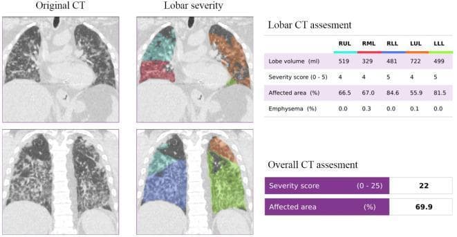 This diagnostic composite image presents a chest CT assessment of a 76-year-old male with COVID-19 pneumonia. It features two coronal CT slices shown in original and color-segmented 'Lobar severity' formats. The original CT scans demonstrate extensive bilateral lung involvement characterized by diffuse ground-glass opacities and multi-focal consolidations. The corresponding lobar severity segments use a deep learning (DL) approach to color-code each lobe (RUL, RML, RLL, LUL, LLL) for quantitative analysis. Accompanying tables provide a 'Lobar CT assessment' detailing specific volumes, severity scores (ranging 0-5), and the percentage of affected area per lobe, with high severity scores of 4 and 5 across all lobes. An 'Overall CT assessment' summarizes the systemic impact with a total severity score of 22 out of 25 and an aggregate affected area of 69.9%. This infographic illustrates the utility of automated DL segmentation in characterizing and quantifying the spatial distribution and severity of viral interstitial pneumonia in a clinical radiology setting.